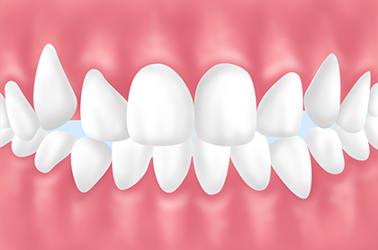 軽度な乱杭歯（叢生）