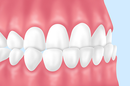 軽度な反対咬合（受け口）
